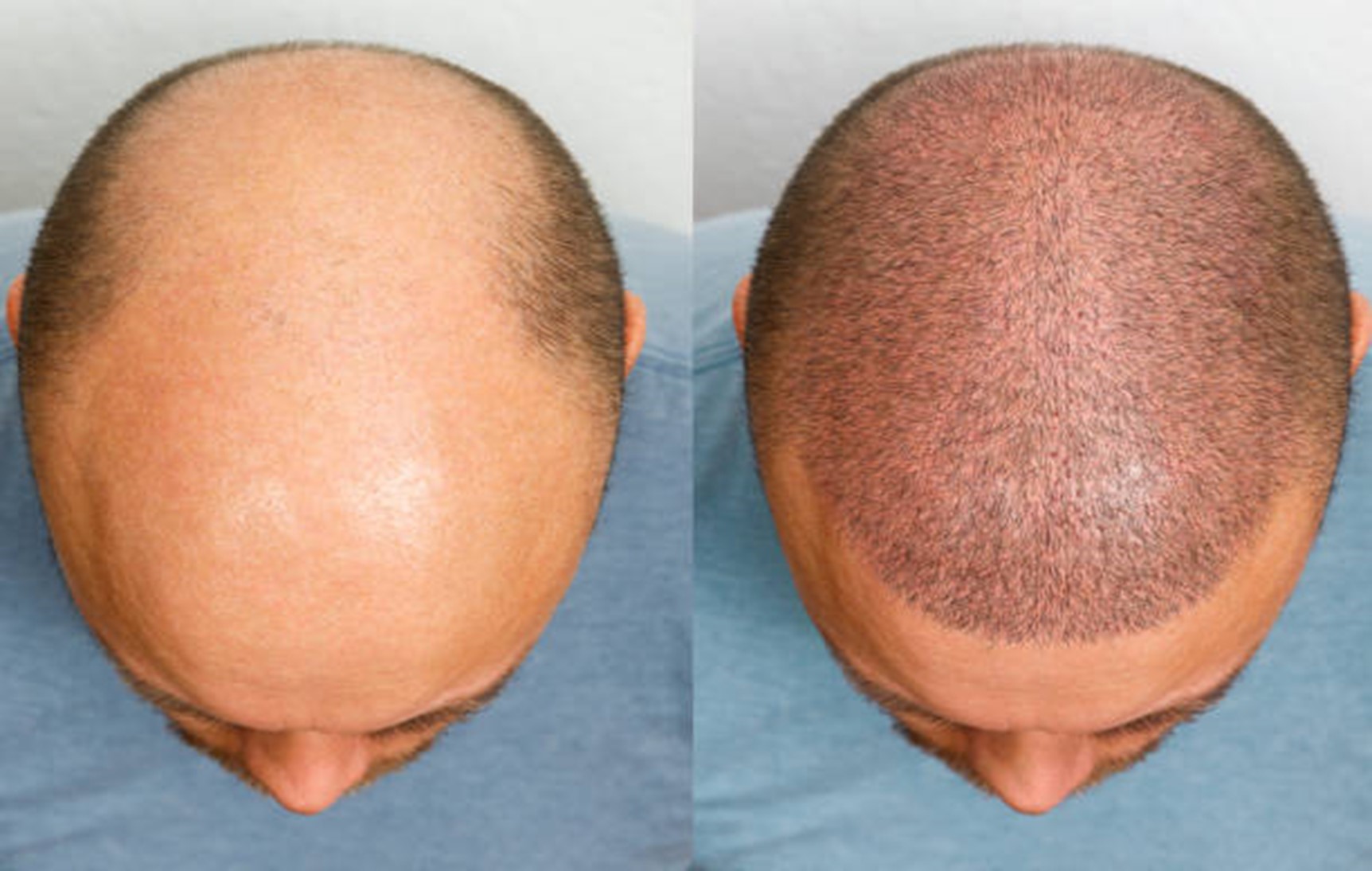 Best Scalp Micropigmentation Solutions