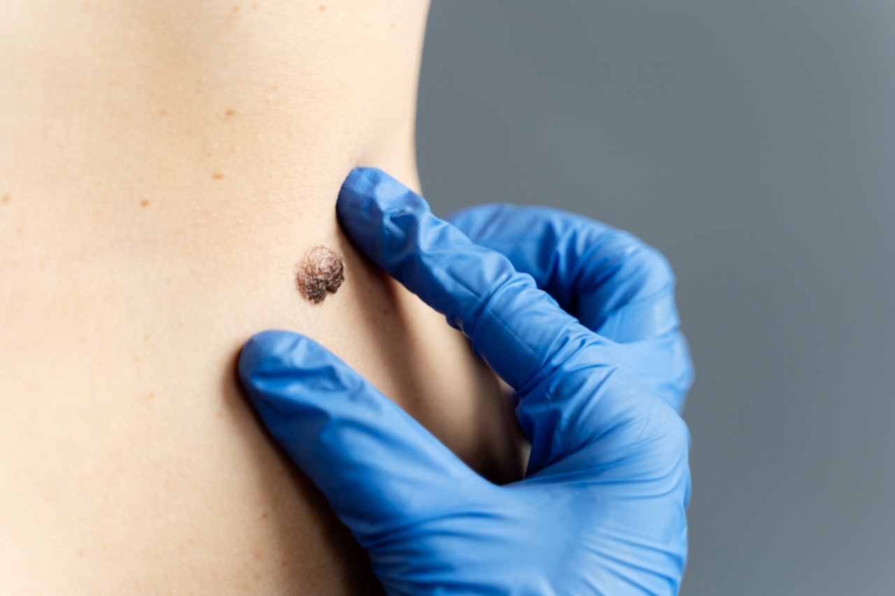 Your Complete Guide to Safe and Effective Mole Removal in Sydney