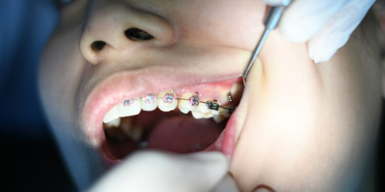 4 Key Considerations for Braces for Teens